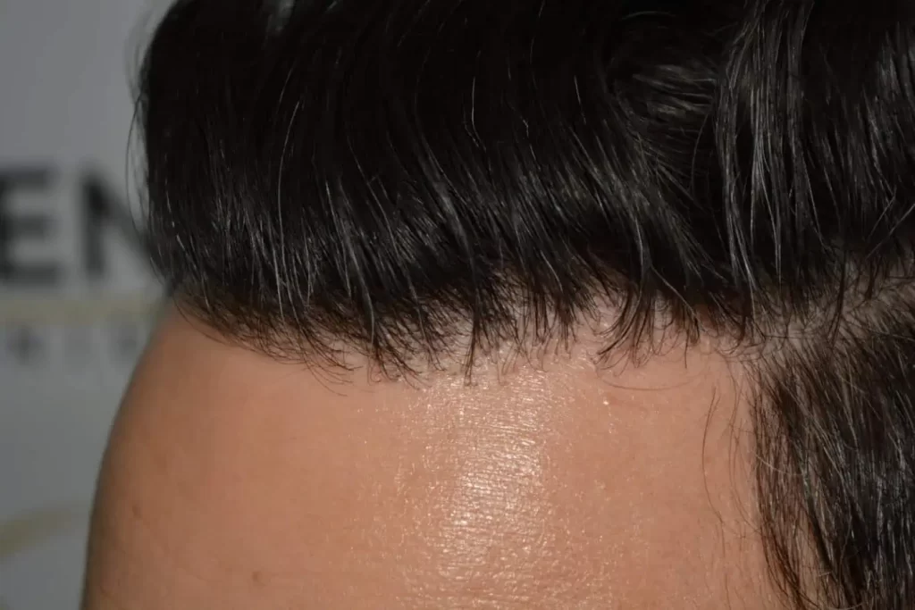 The Bollywood Hairline
