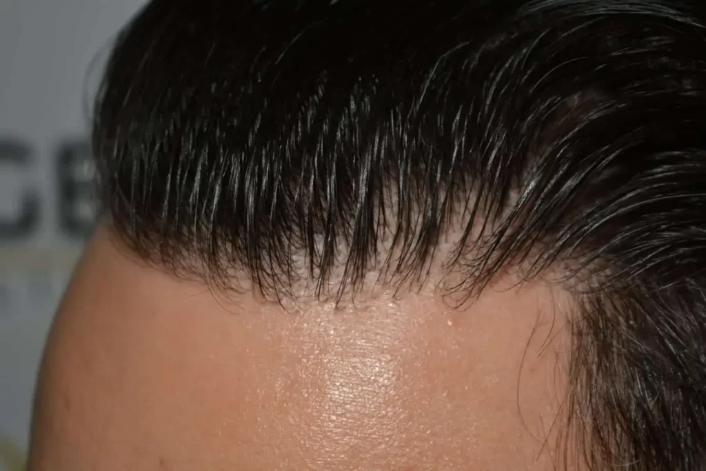 The Bollywood Hairline