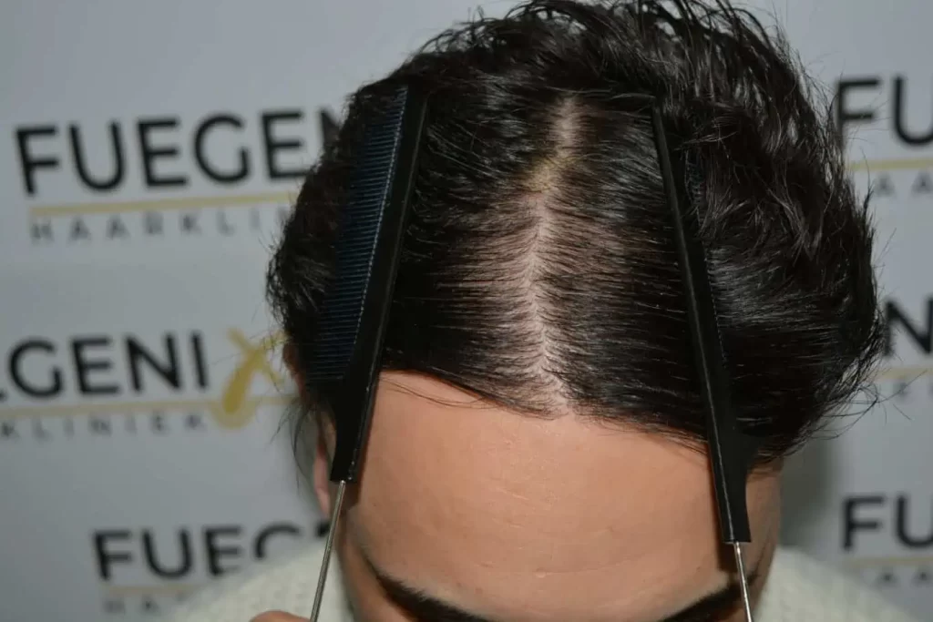 The Bollywood Hairline