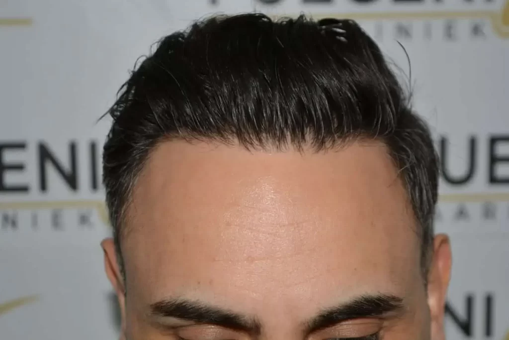 The Bollywood Hairline