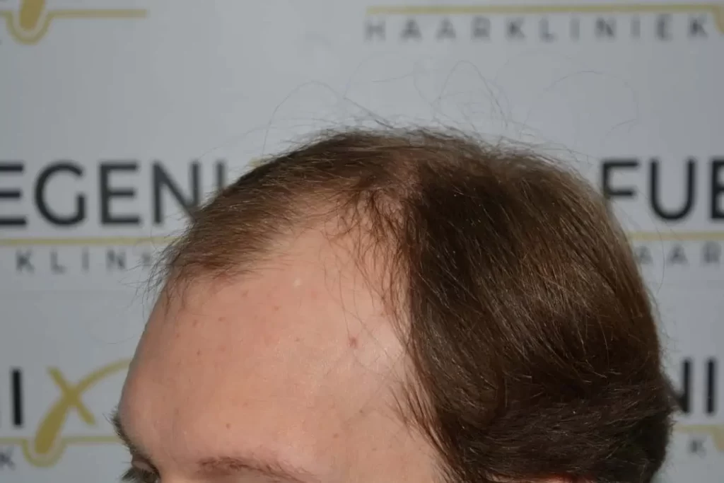 Front Midscalp In One Sitting