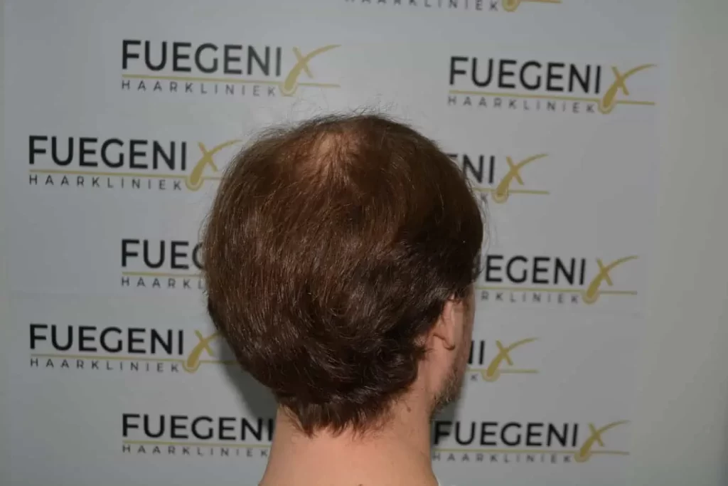Front Midscalp In One Sitting