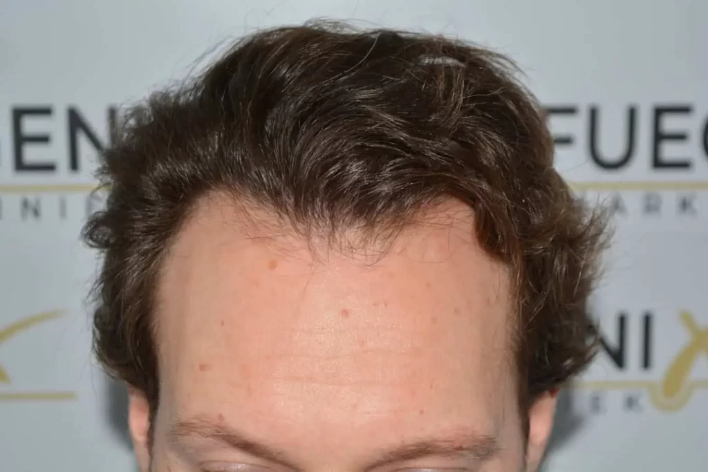 Front Midscalp In One Sitting