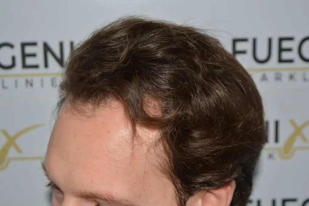 Front Midscalp In One Sitting