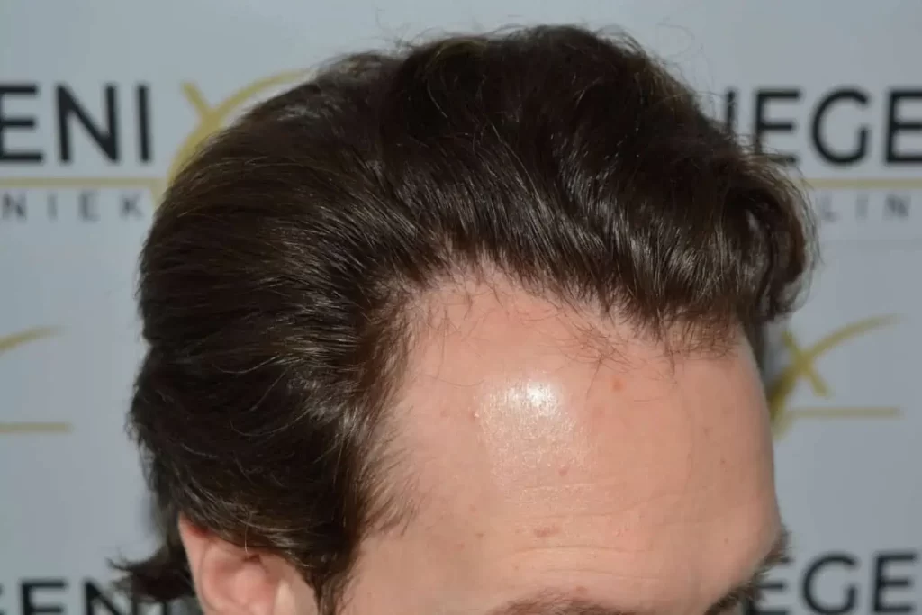 Front Midscalp In One Sitting