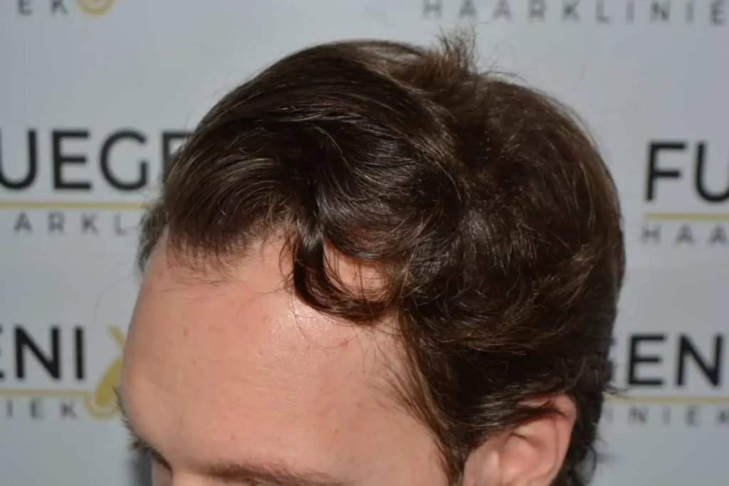 Front Midscalp In One Sitting