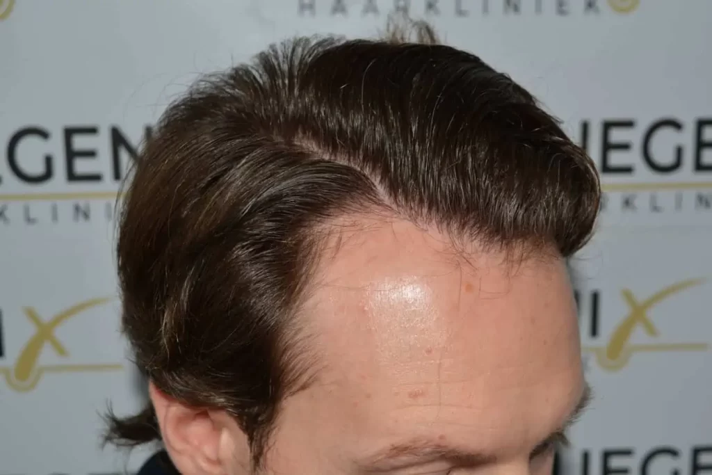 Front Midscalp In One Sitting