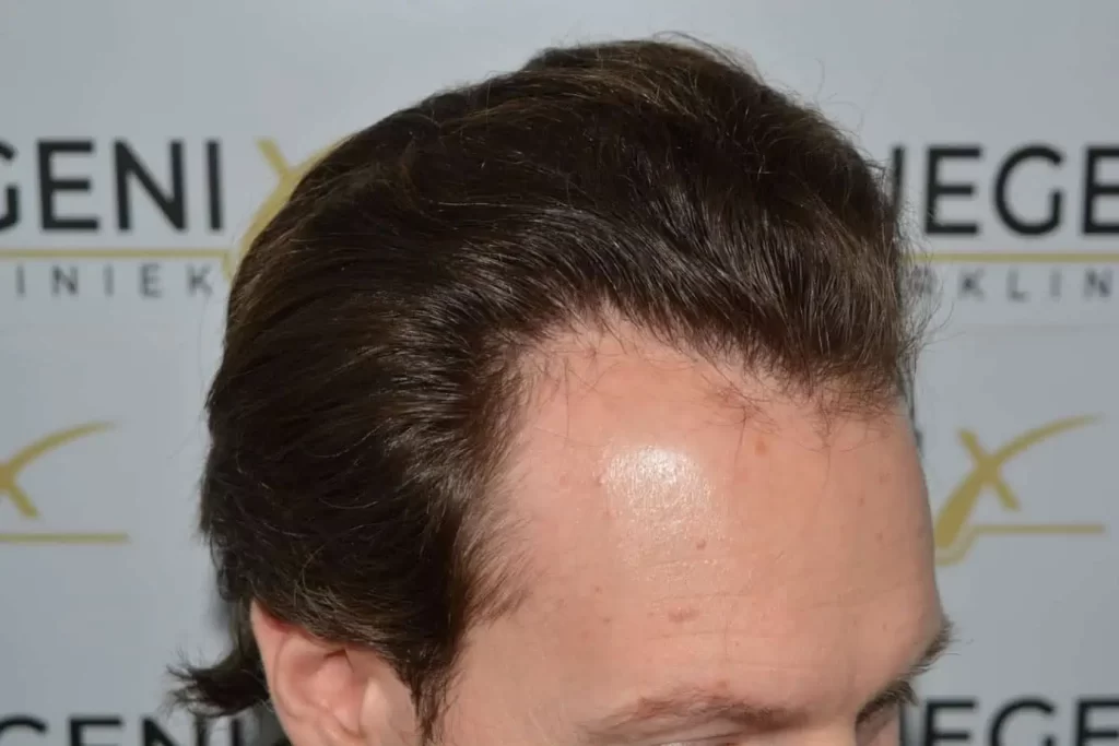 Front Midscalp In One Sitting