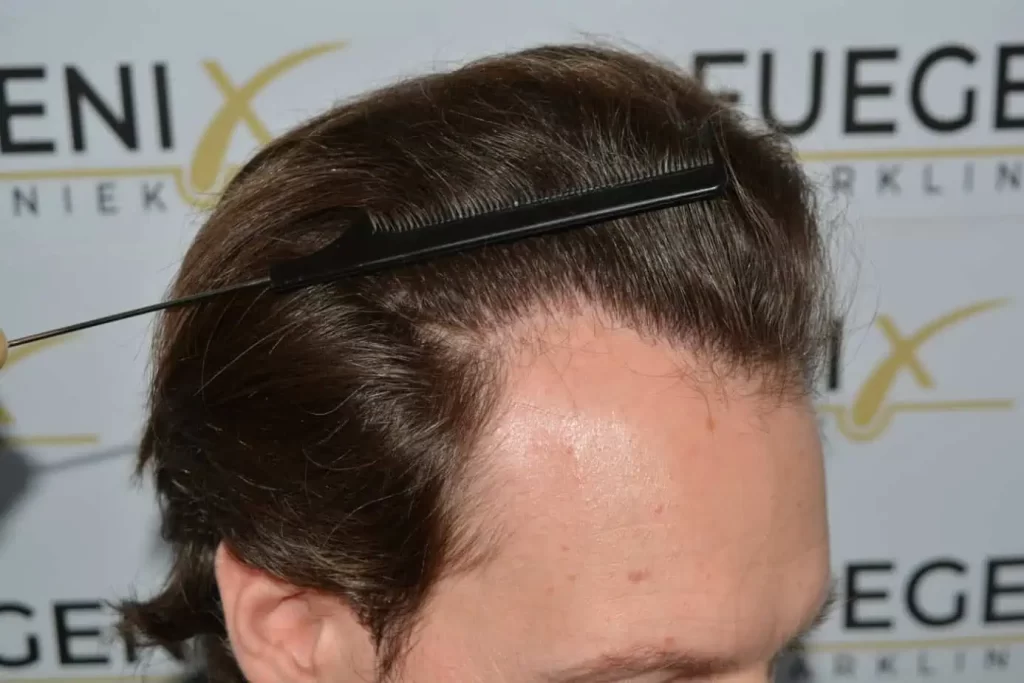 Front Midscalp In One Sitting