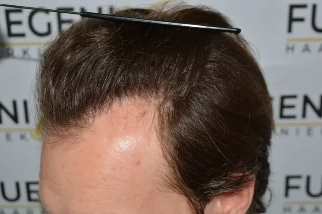 Front Midscalp In One Sitting