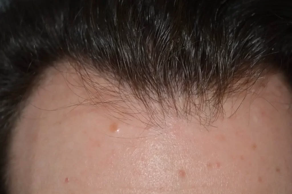 Front Midscalp In One Sitting