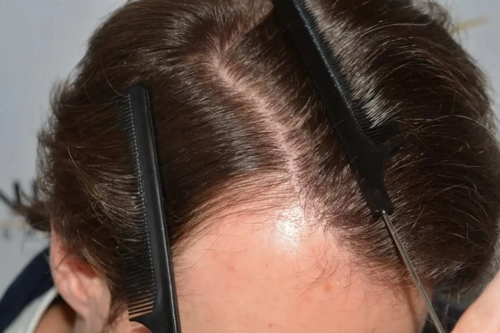 Front Midscalp In One Sitting