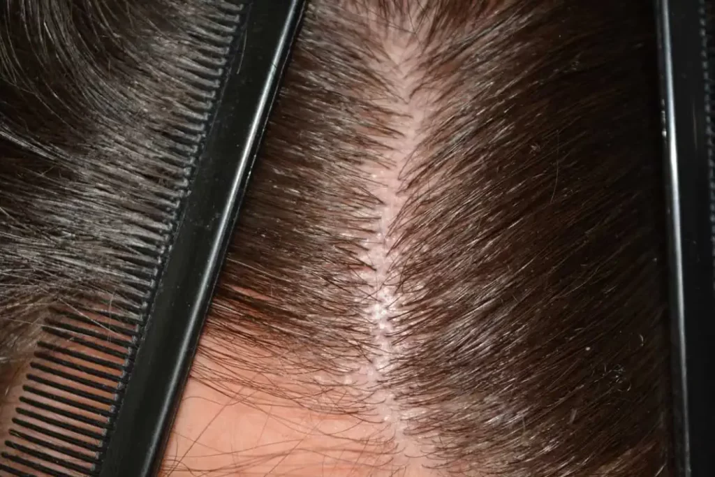 Front Midscalp In One Sitting