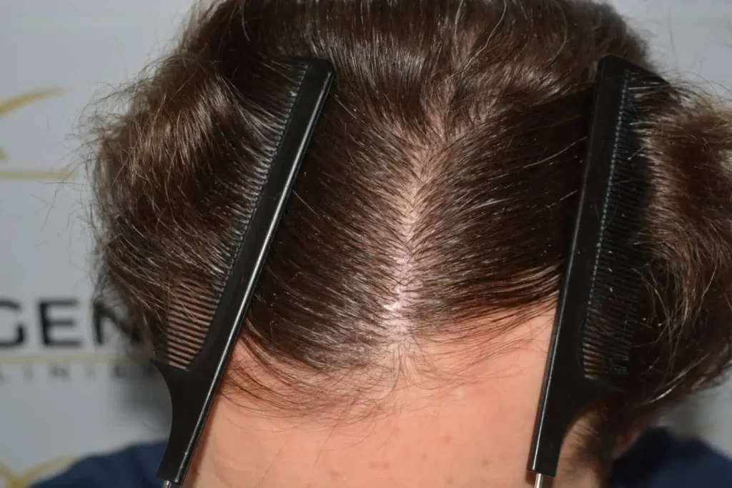 Front Midscalp In One Sitting