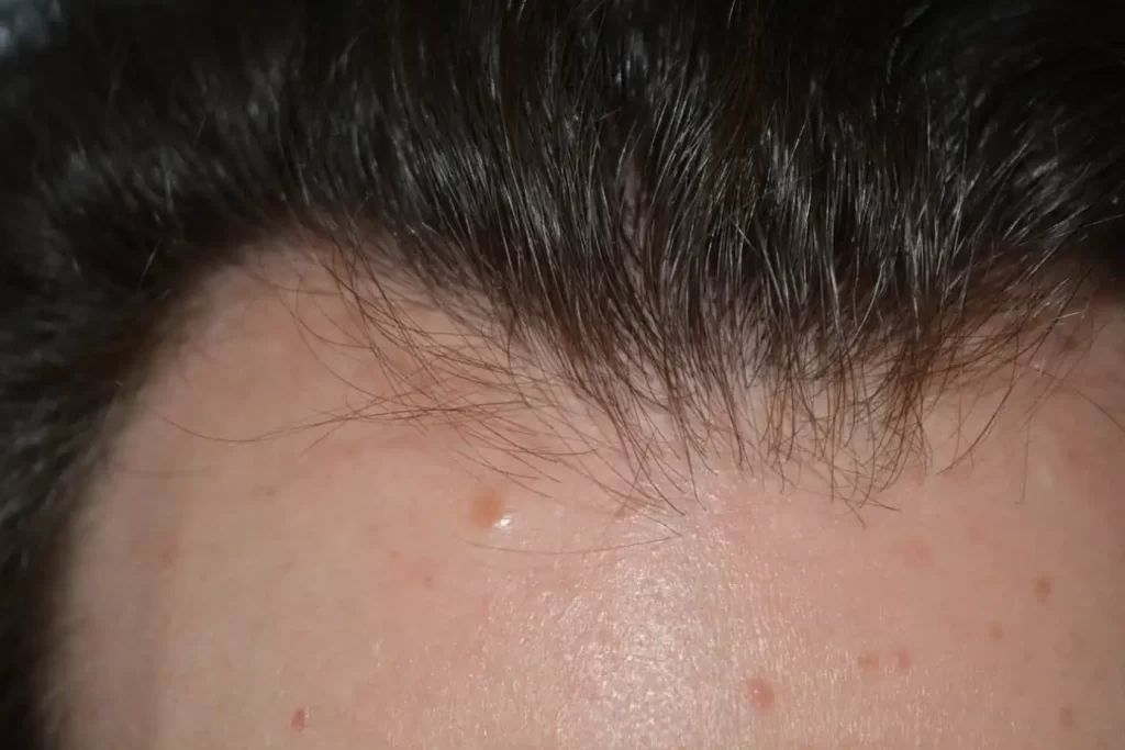 Front Midscalp In One Sitting