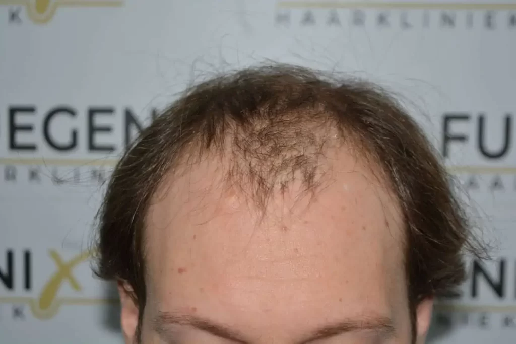 Front Midscalp In One Sitting