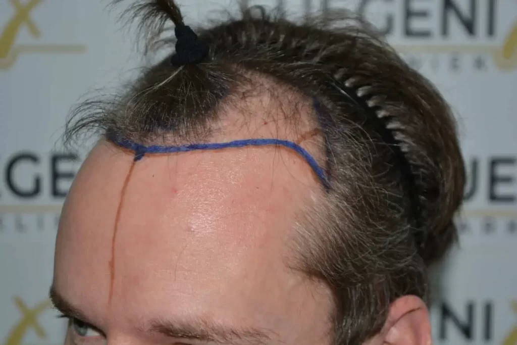 The Henry Cavill Hairline
