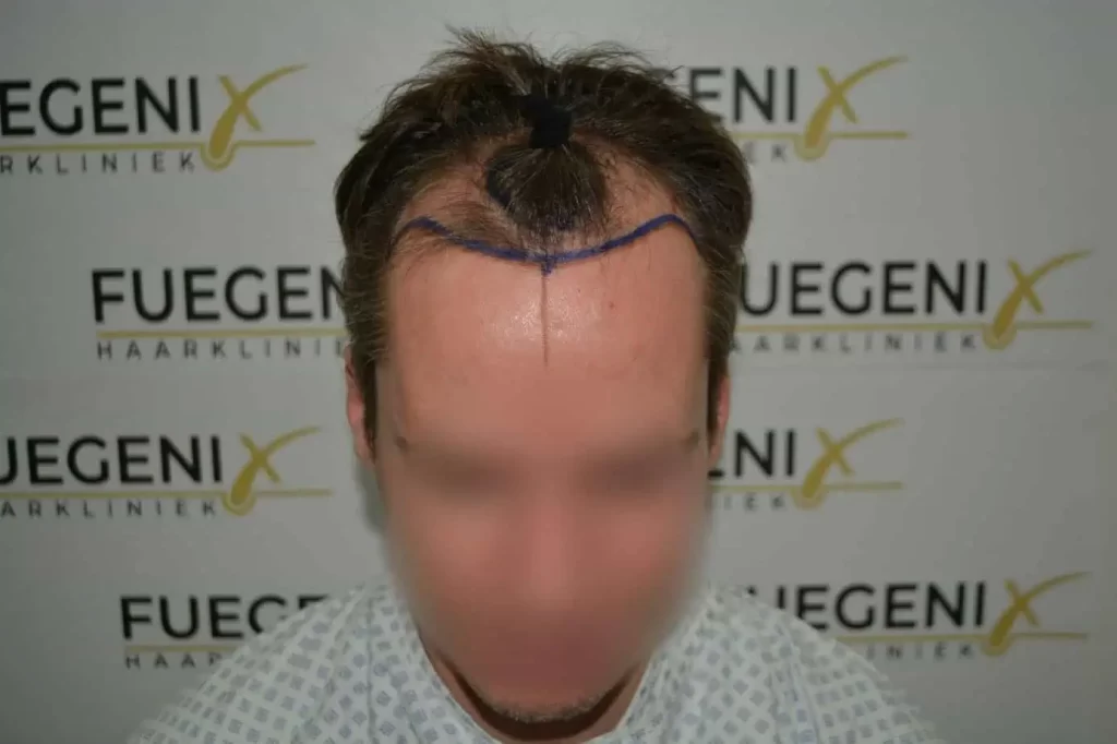 The Henry Cavill Hairline