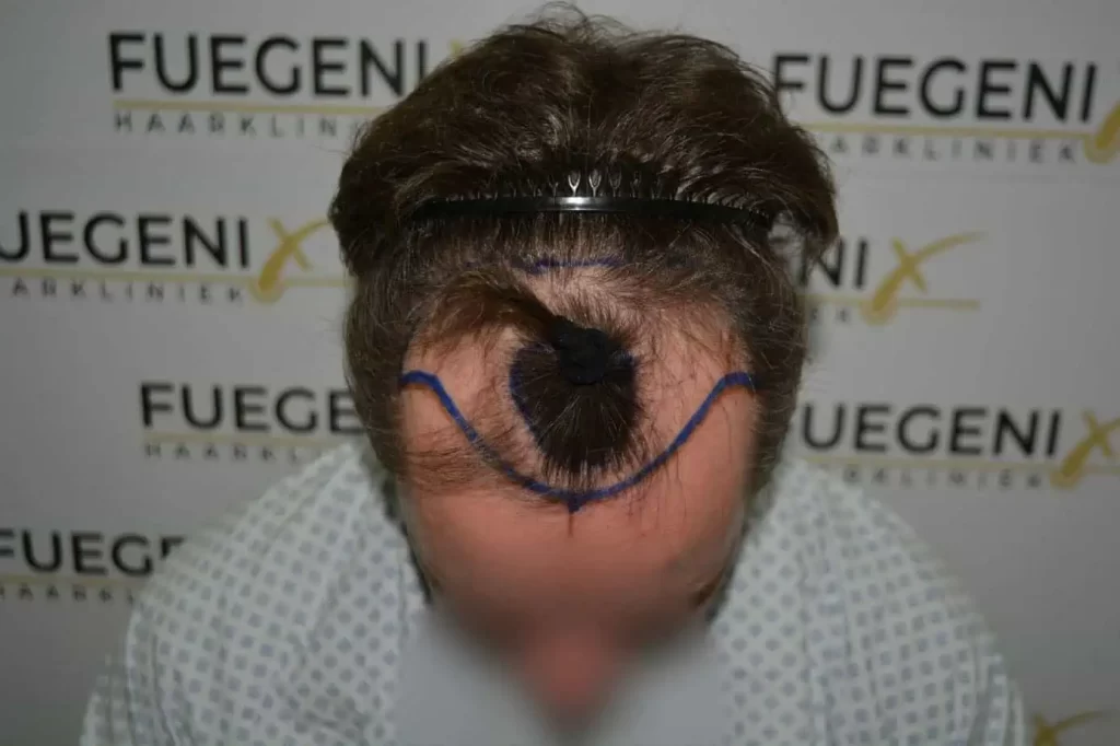 The Henry Cavill Hairline