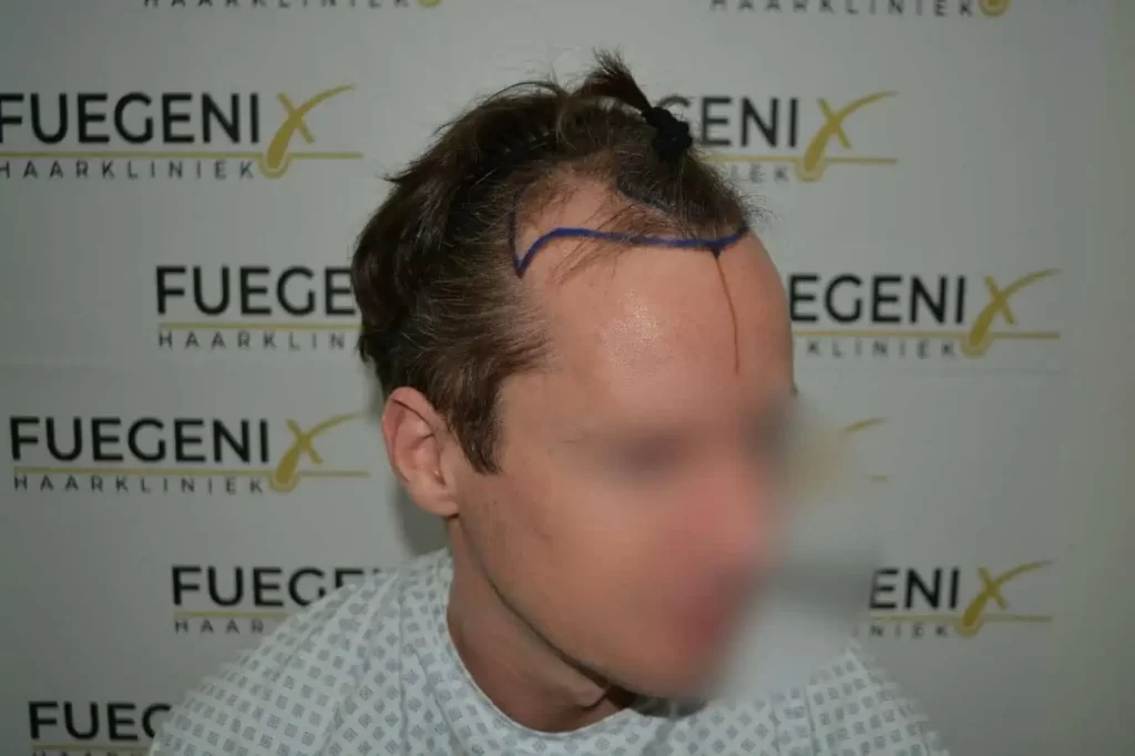 The Henry Cavill Hairline