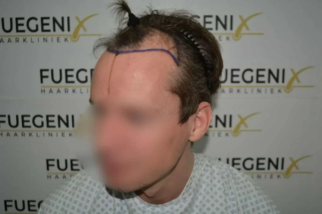 The Henry Cavill Hairline