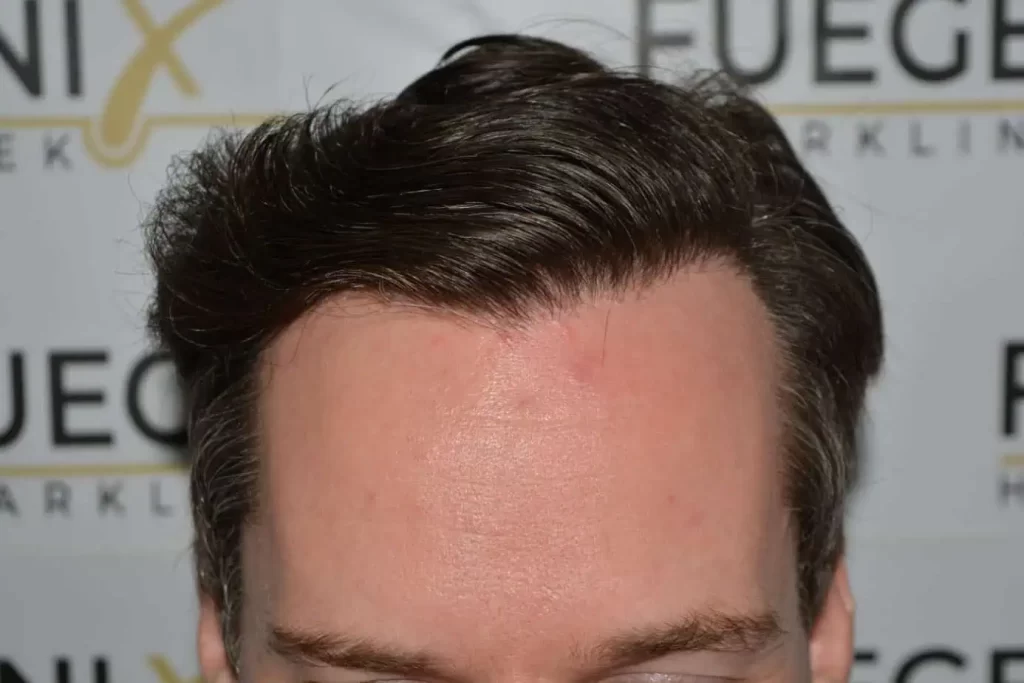 The Henry Cavill Hairline