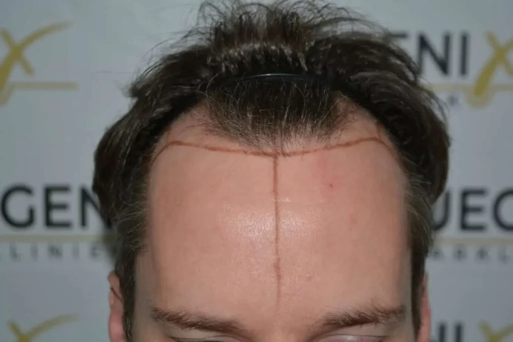 The Henry Cavill Hairline