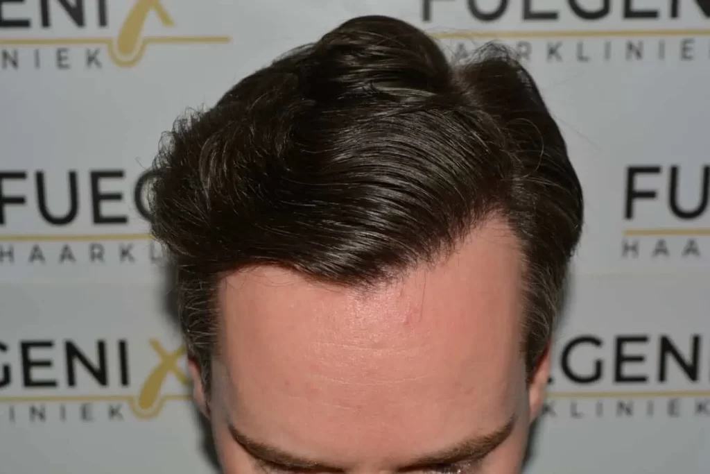 The Henry Cavill Hairline