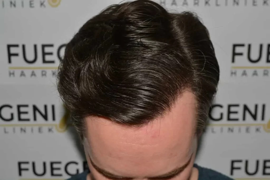 The Henry Cavill Hairline