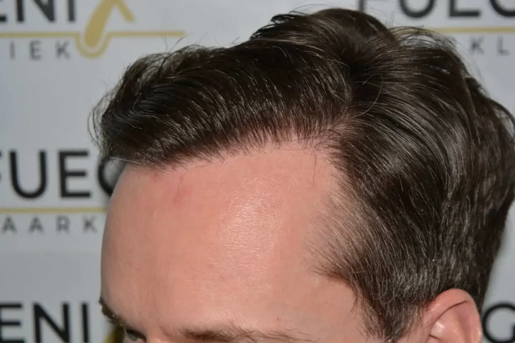The Henry Cavill Hairline