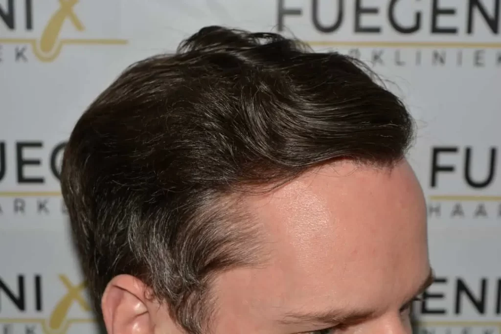The Henry Cavill Hairline