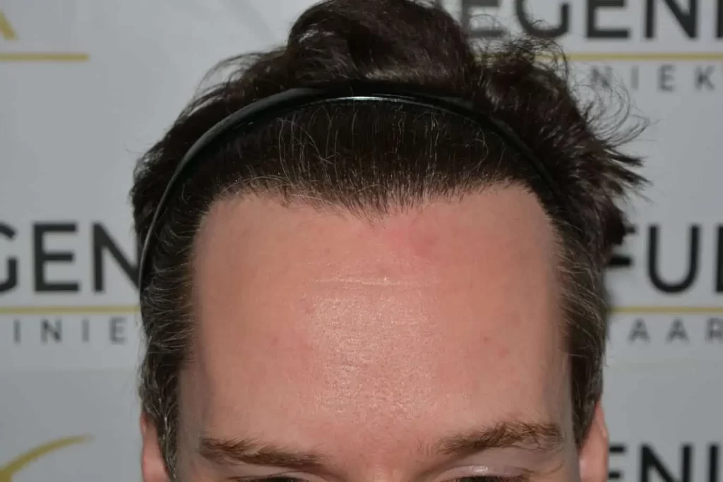 The Henry Cavill Hairline