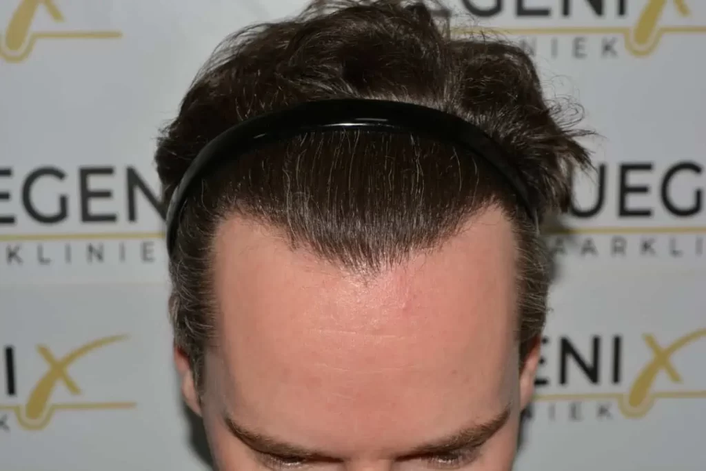 The Henry Cavill Hairline