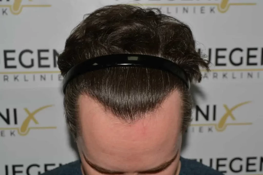 The Henry Cavill Hairline