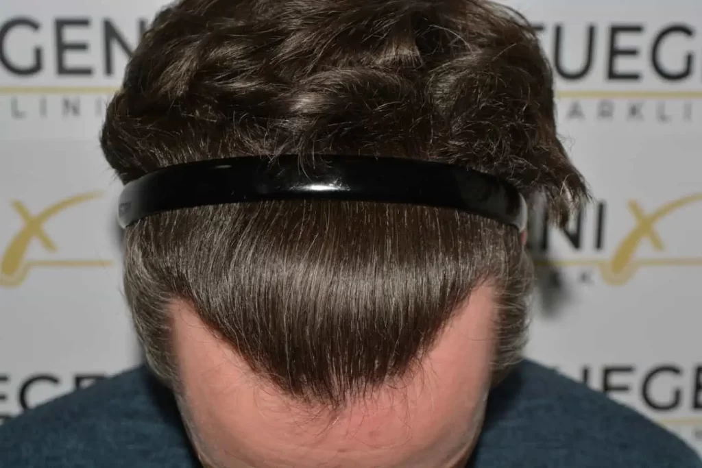 The Henry Cavill Hairline