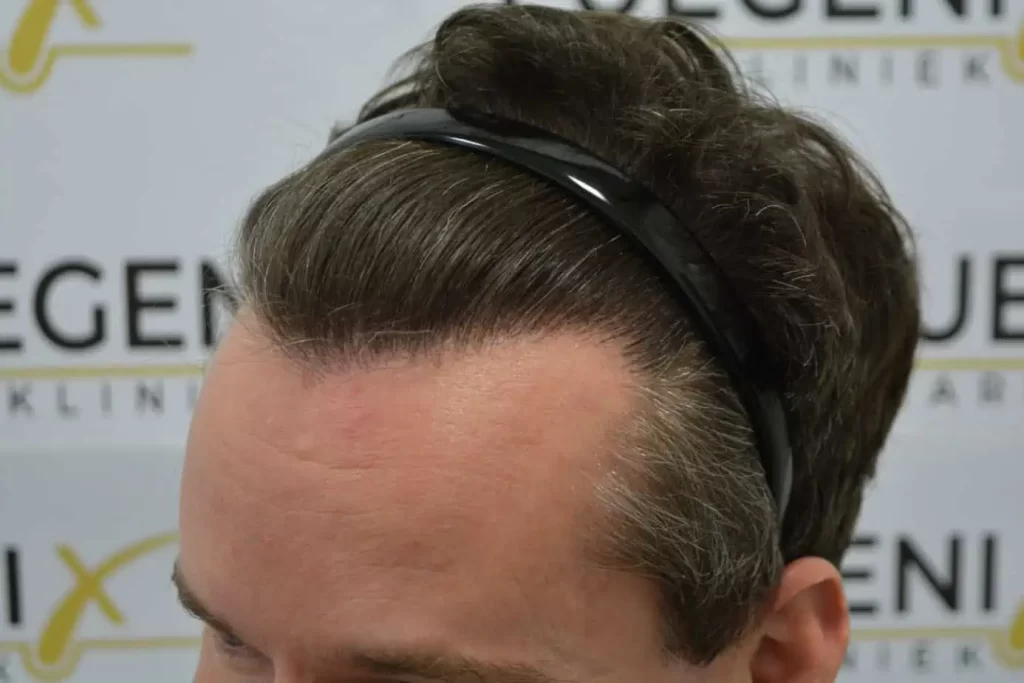 The Henry Cavill Hairline