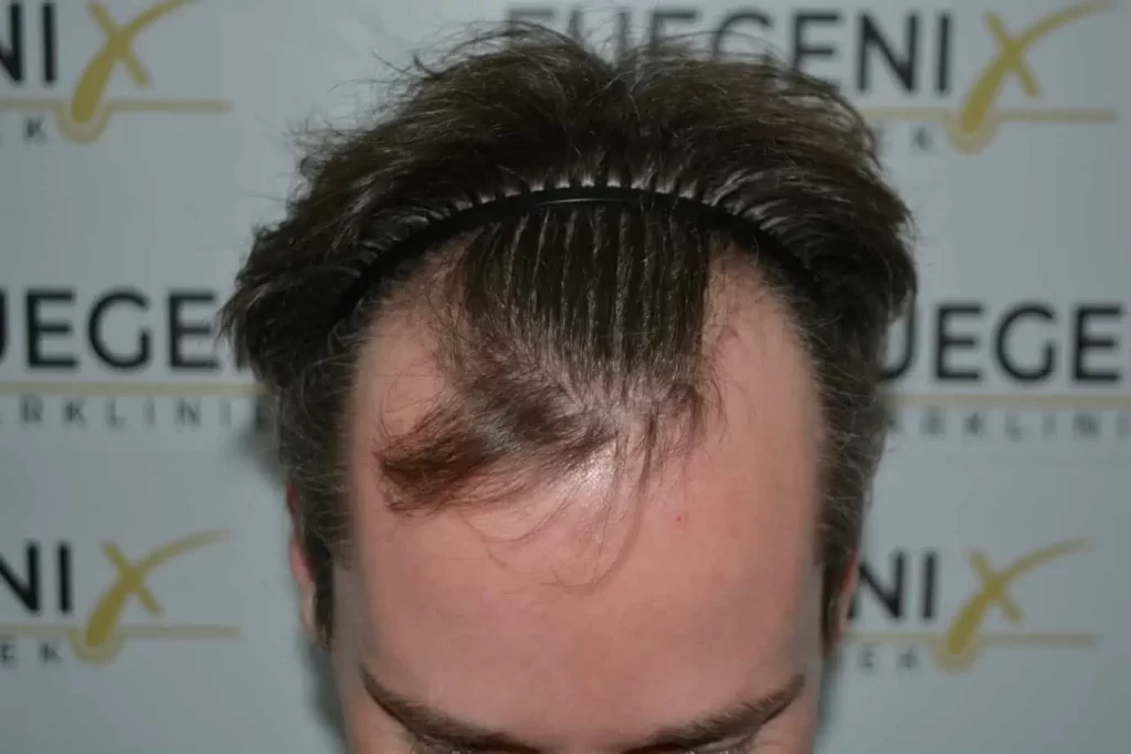 The Henry Cavill Hairline