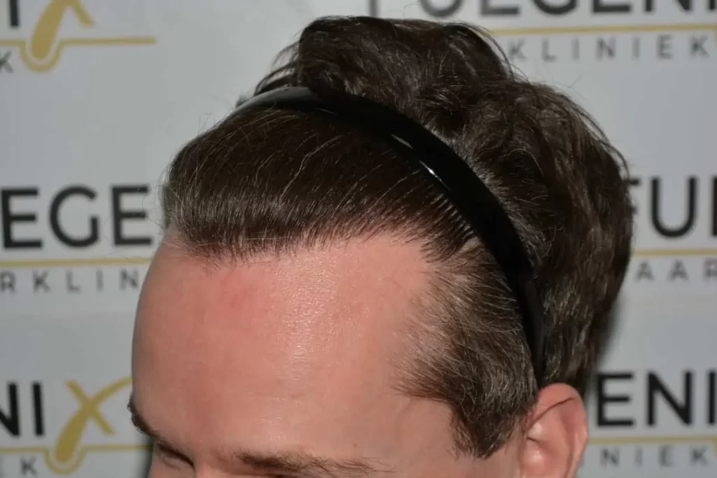 The Henry Cavill Hairline