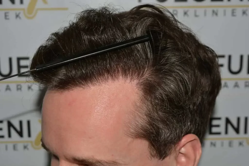 The Henry Cavill Hairline