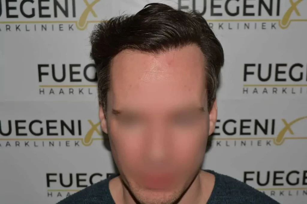The Henry Cavill Hairline