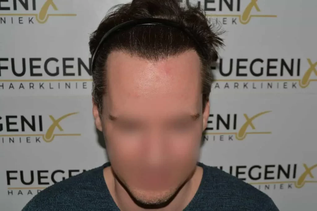 The Henry Cavill Hairline