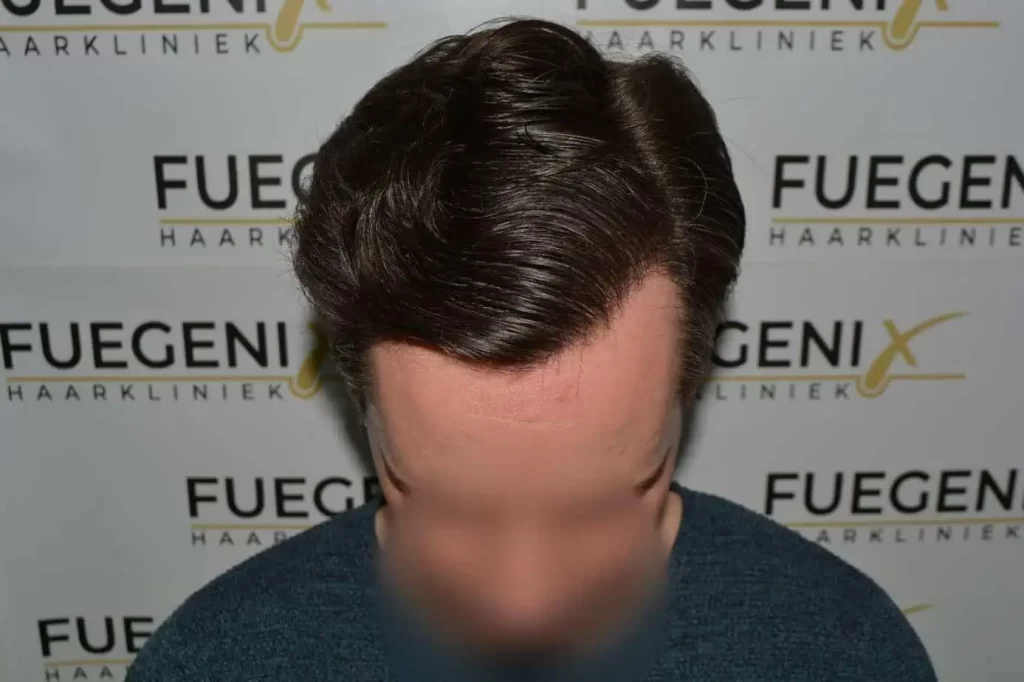 The Henry Cavill Hairline