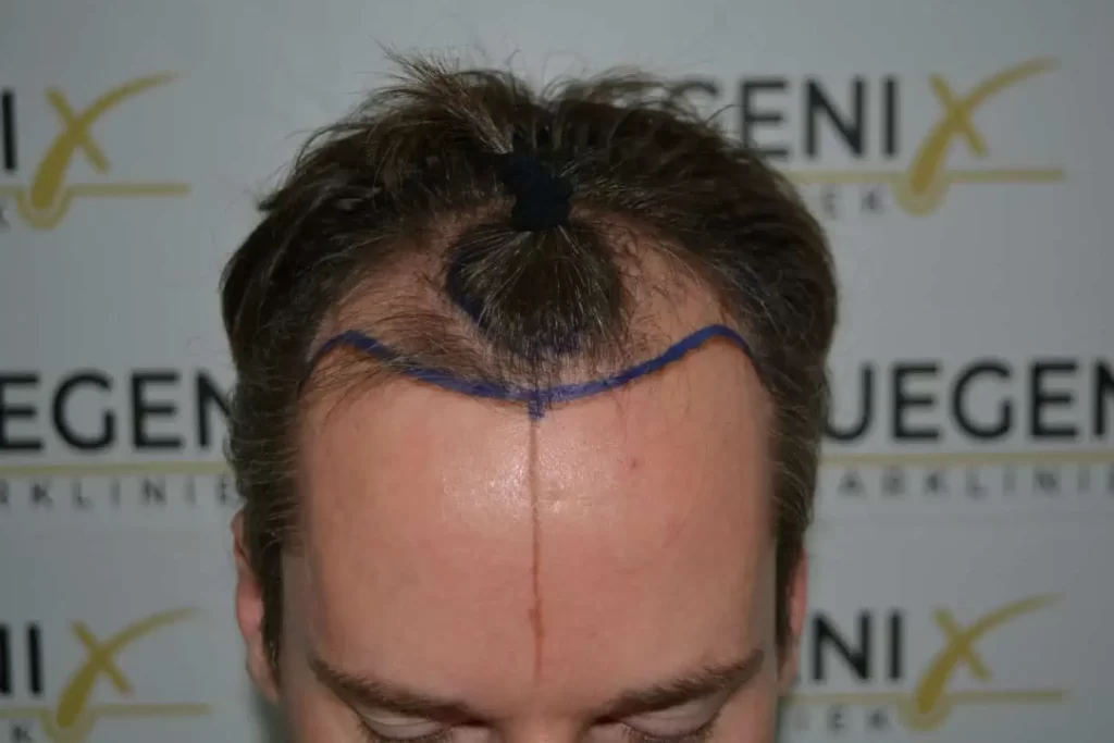 The Henry Cavill Hairline