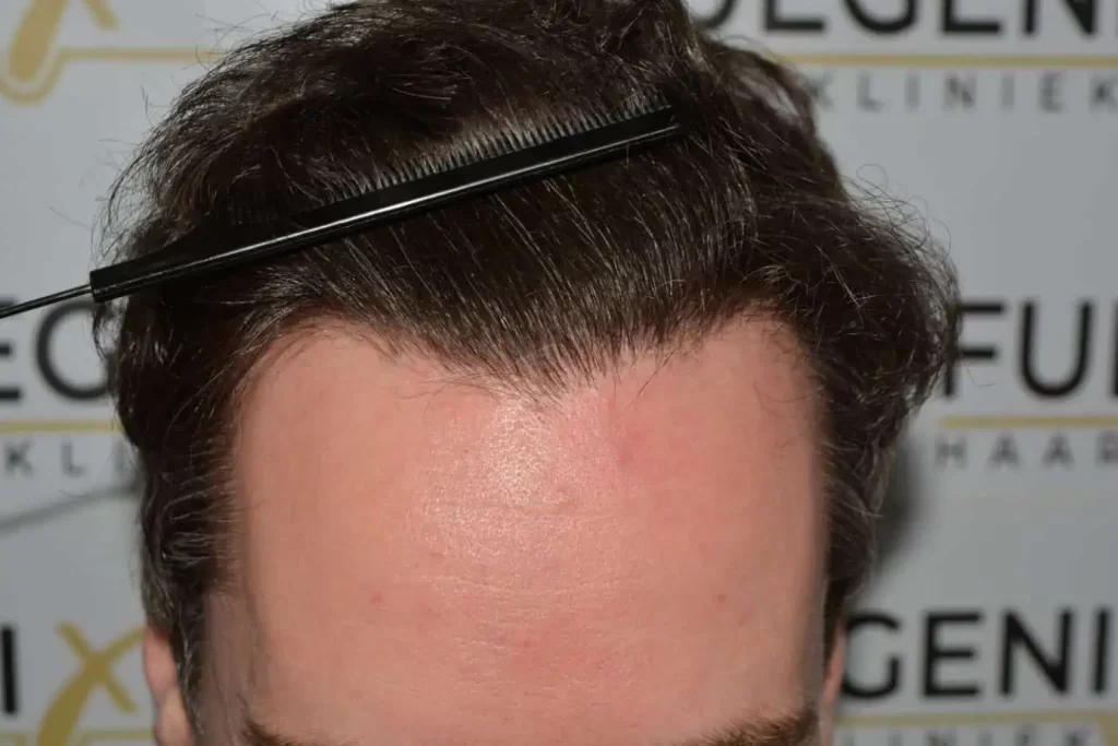 The Henry Cavill Hairline
