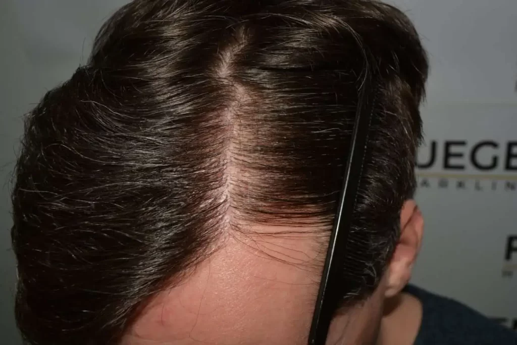 The Henry Cavill Hairline