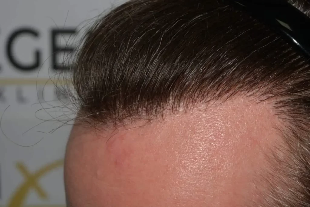 The Henry Cavill Hairline