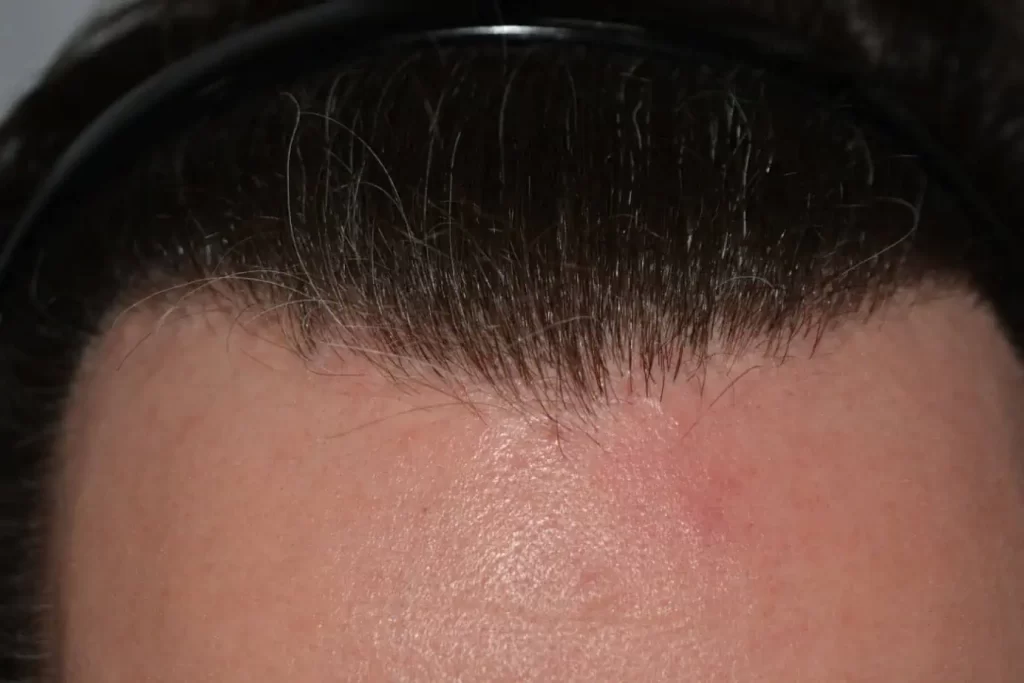 The Henry Cavill Hairline