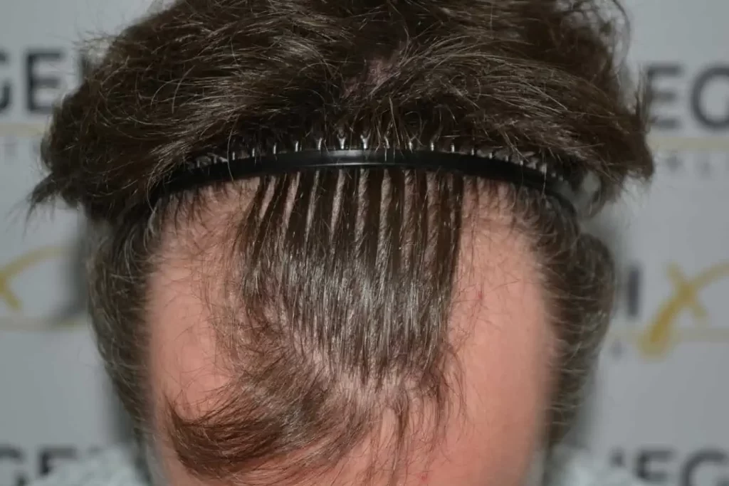 The Henry Cavill Hairline