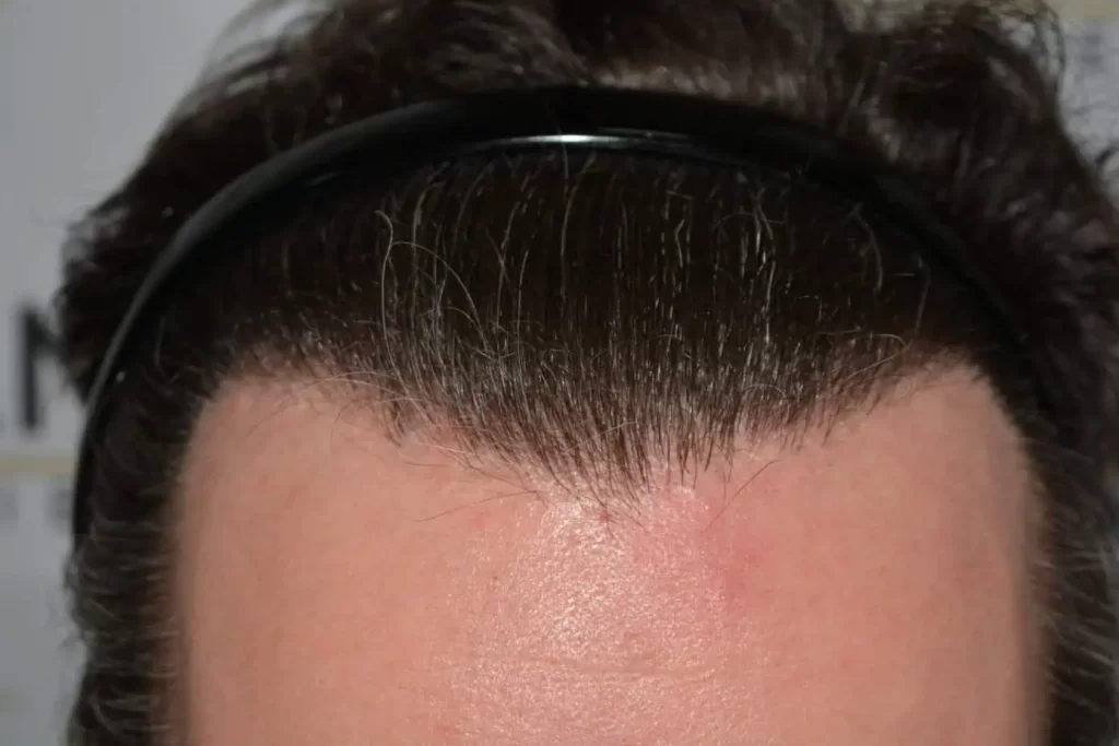 The Henry Cavill Hairline