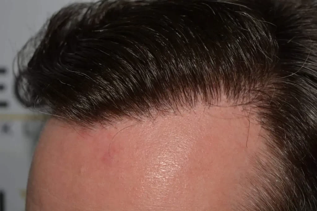 The Henry Cavill Hairline
